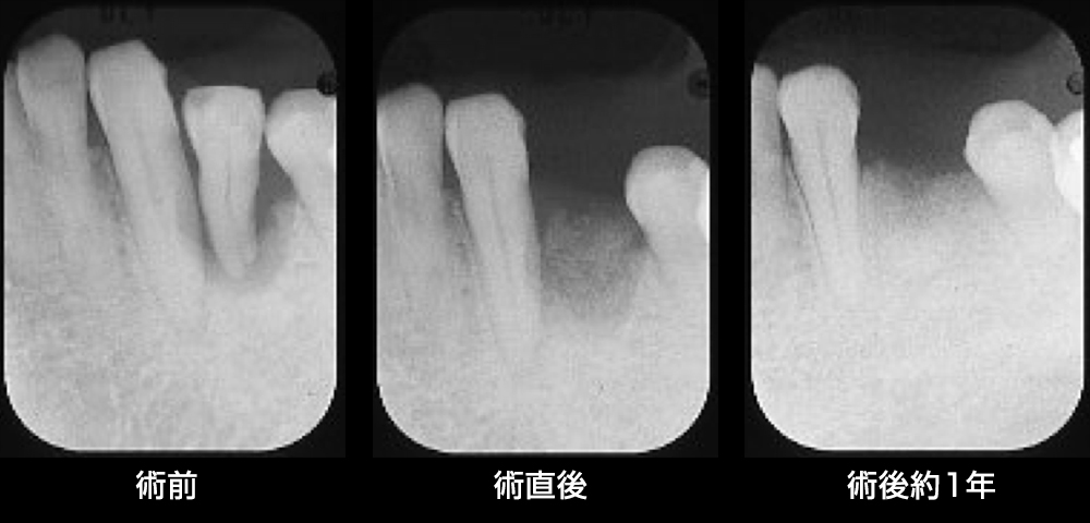 Case5 再生療法